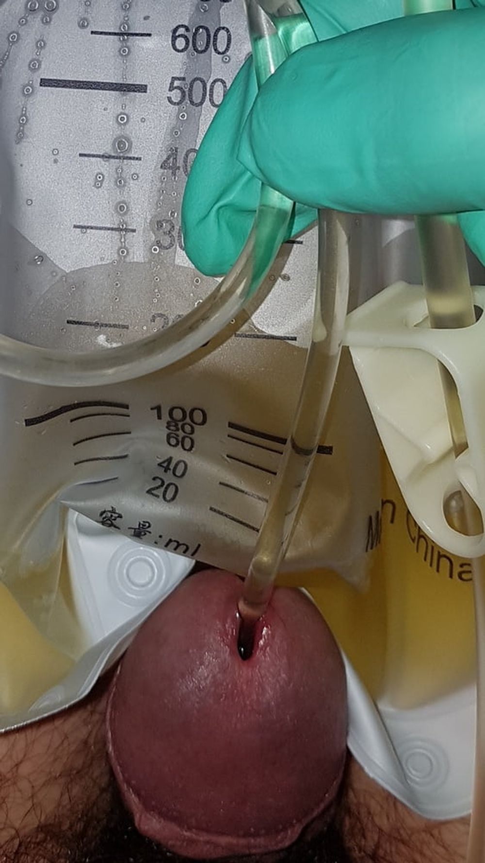 Catheter sounding with my urine 2 #13