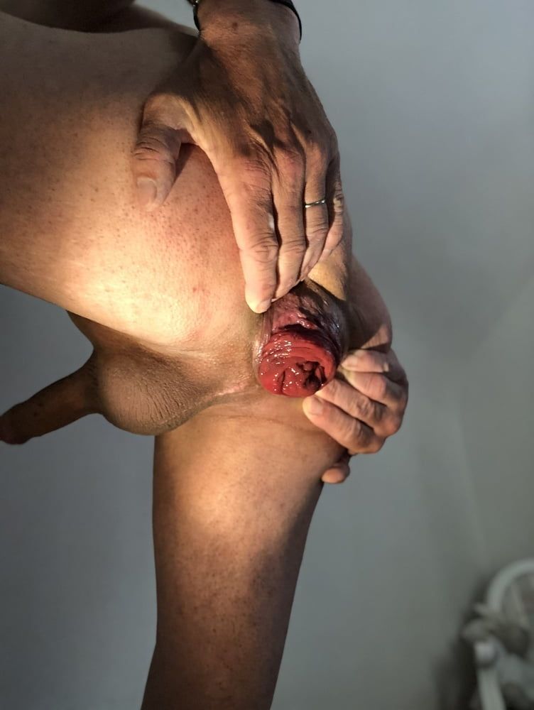 dilatation prolapse anal #2