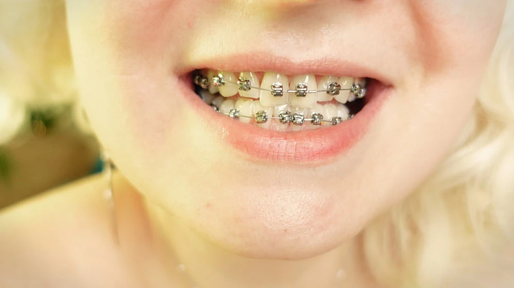 braces! #26