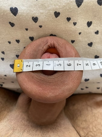 Extreme foreskin stretching