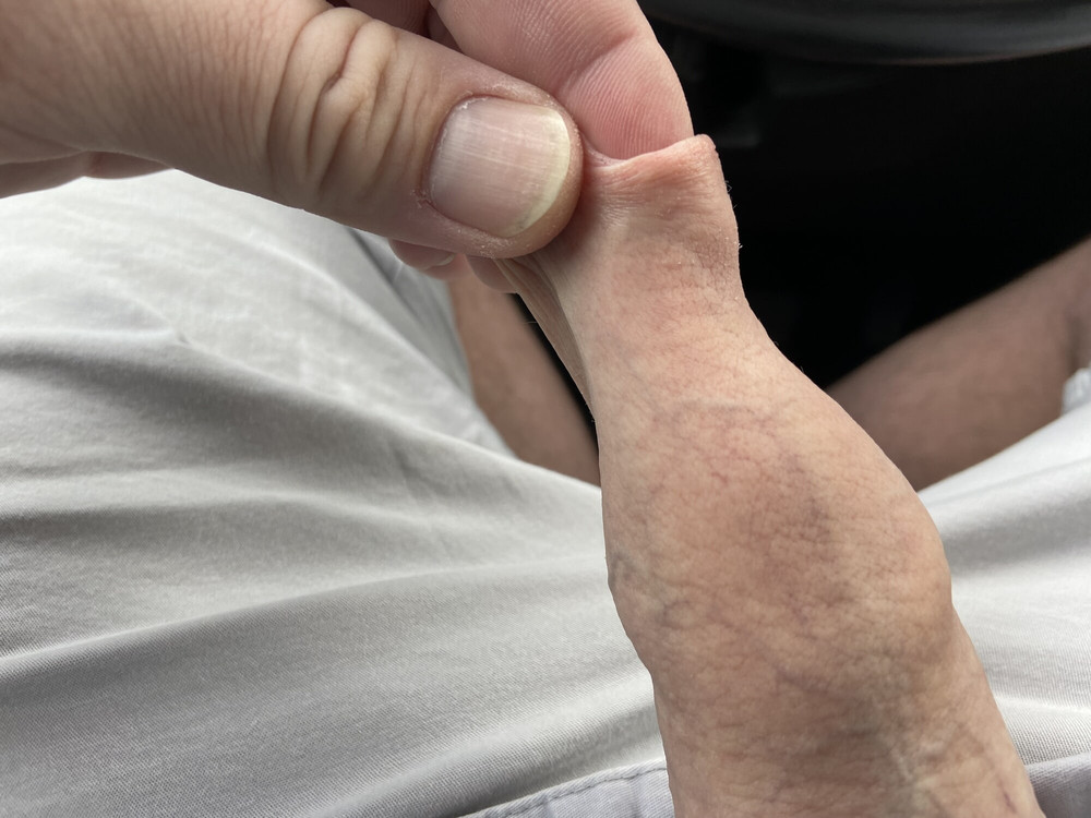 Foreskin #4