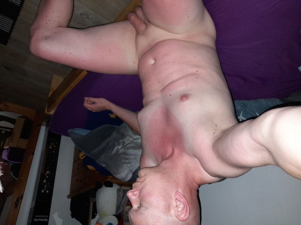 Sunburn, these embrassing tan lines say it all