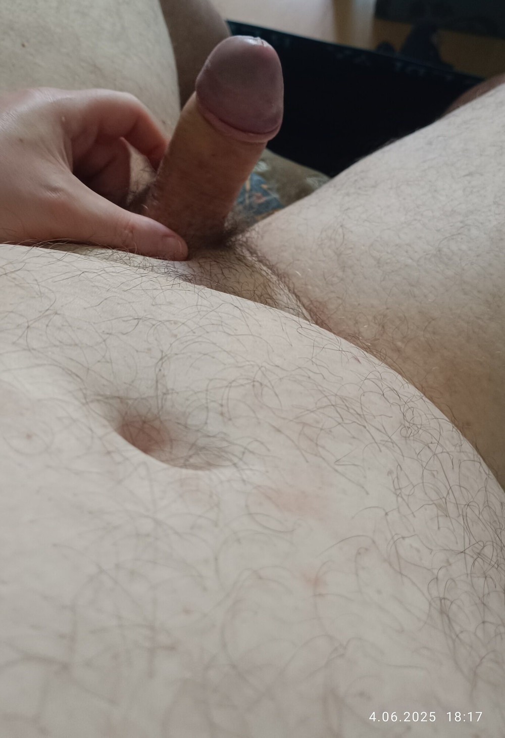 Full erection after phimosis removal and one month after sur #2