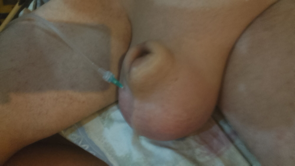 2L D5NS infusion transforming my sac into a beach ball #6