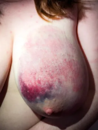 my bruised tits after a rough bdsm session         