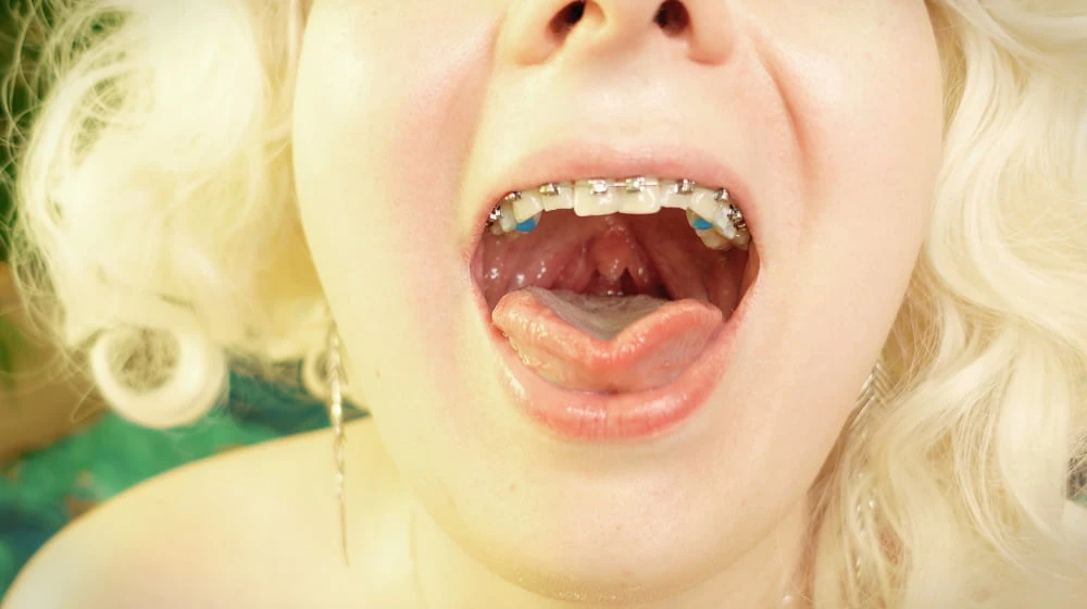 braces! #42