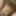Micropenis tiny cock
