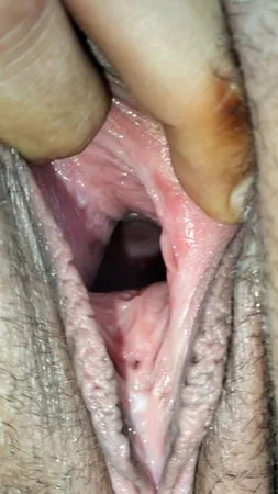 cum covered cervix         