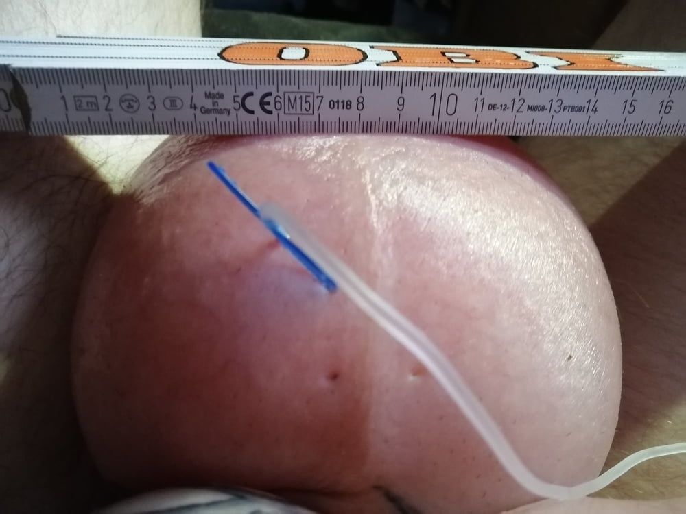saline infusion scrotum - more as 2 l #40