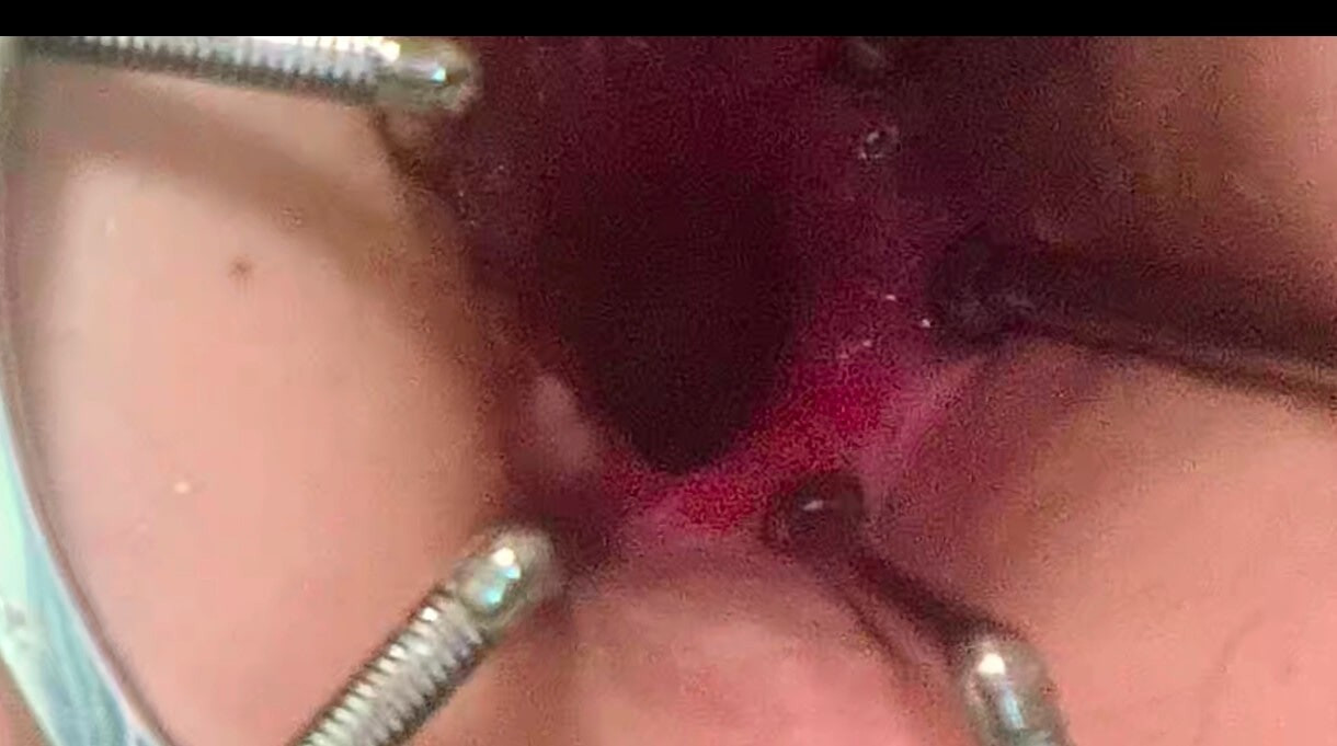 Anal