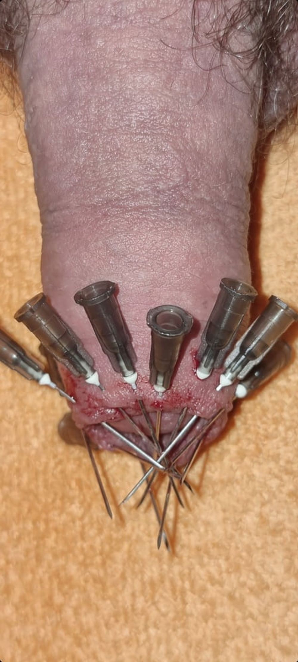 CBT Needles #13