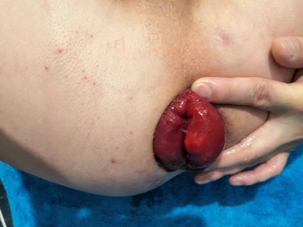 extreme prolapse pumping