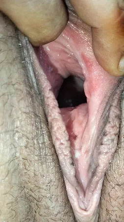 cum covered cervix         