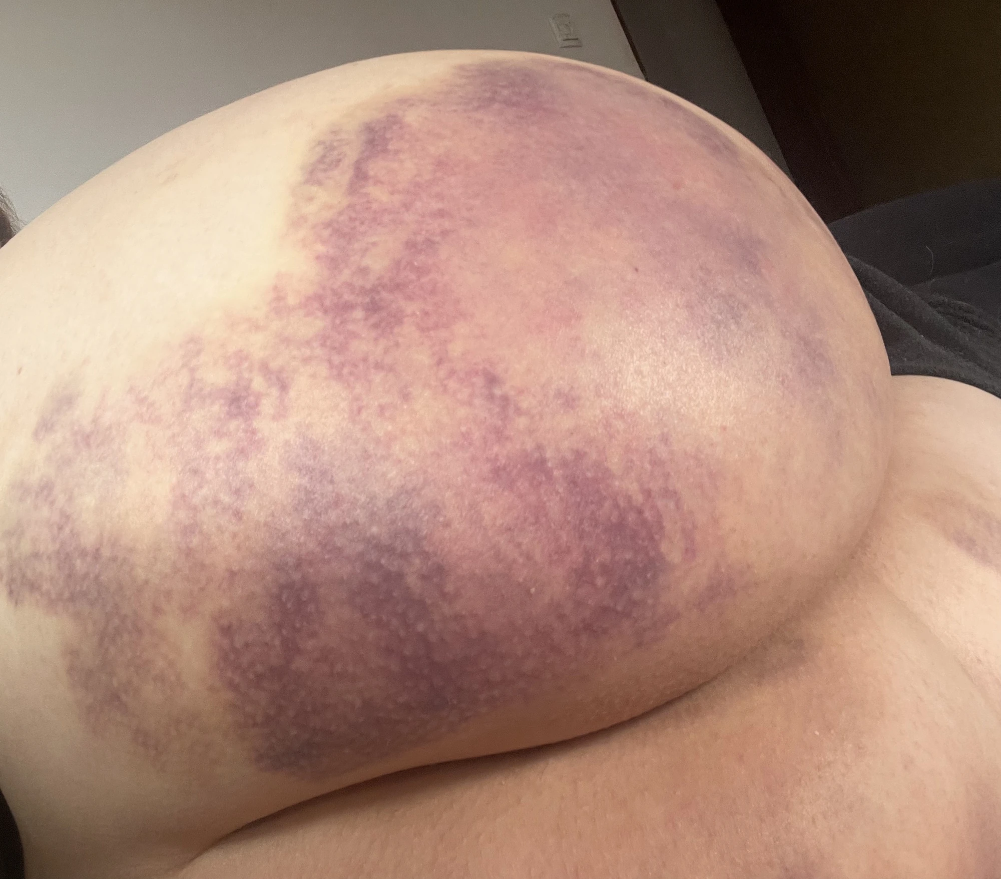 Two days after spanking #14