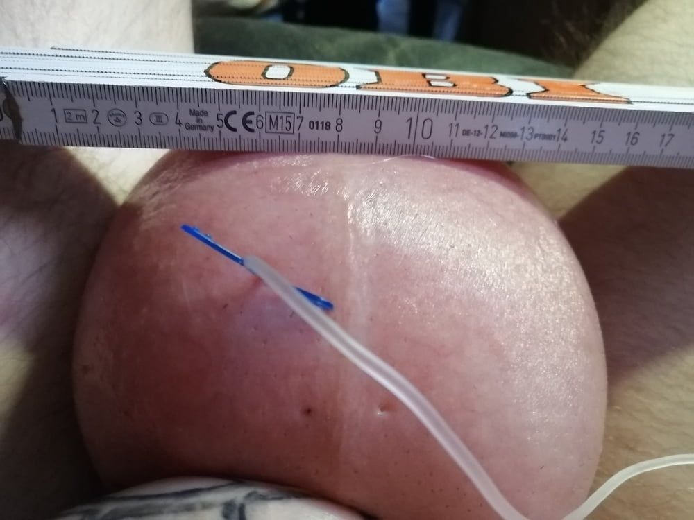 saline infusion scrotum - more as 2 l #39