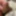 inflation foreskin