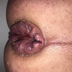 我脱垂的菊花